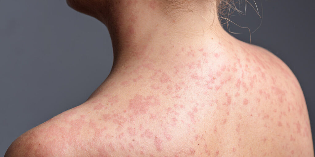 Measles